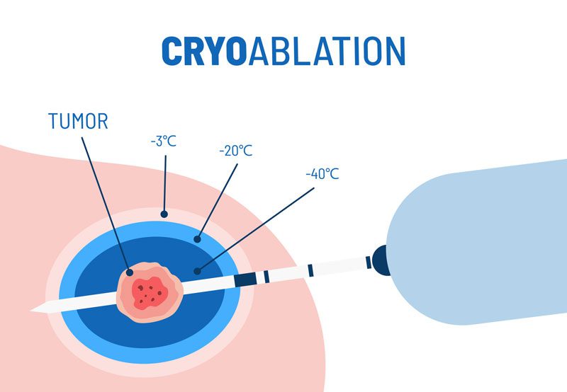 Cryoablation-tumor-treatment-diagram Cryoablation-tumor-treatment-diagram