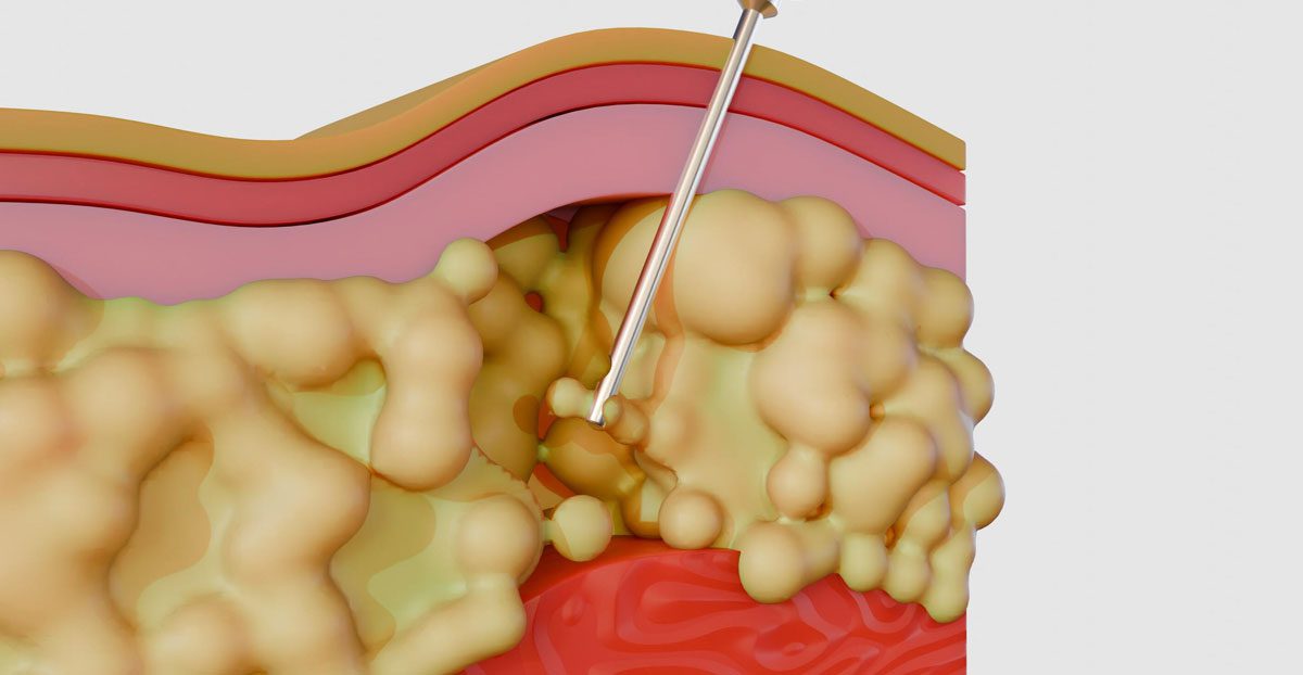 Kidney-tumor-ablation-illustration Kidney-tumor-ablation-illustration